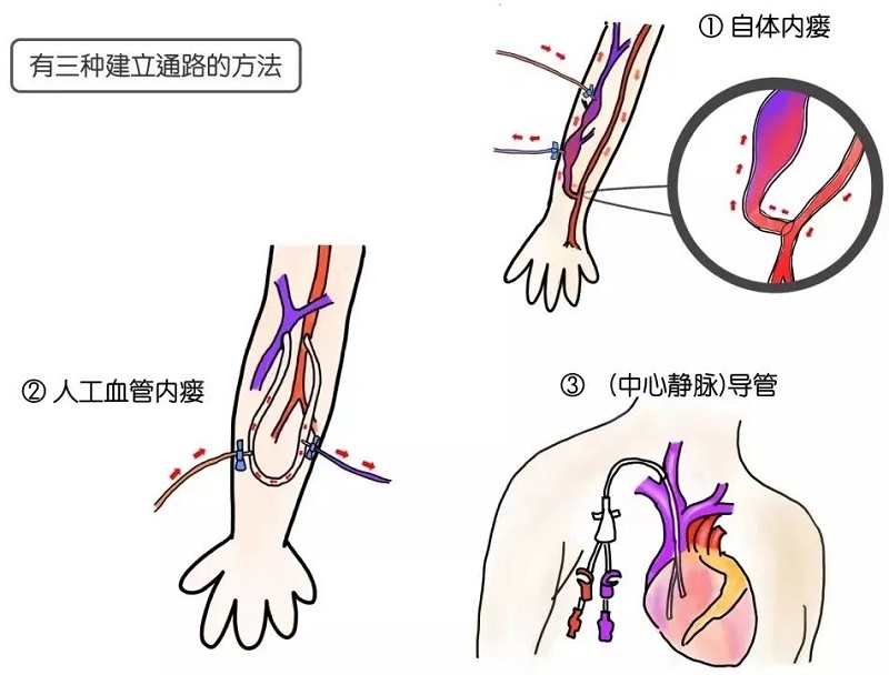 血管通路多學科診療模式，守護血透患者“生命線”