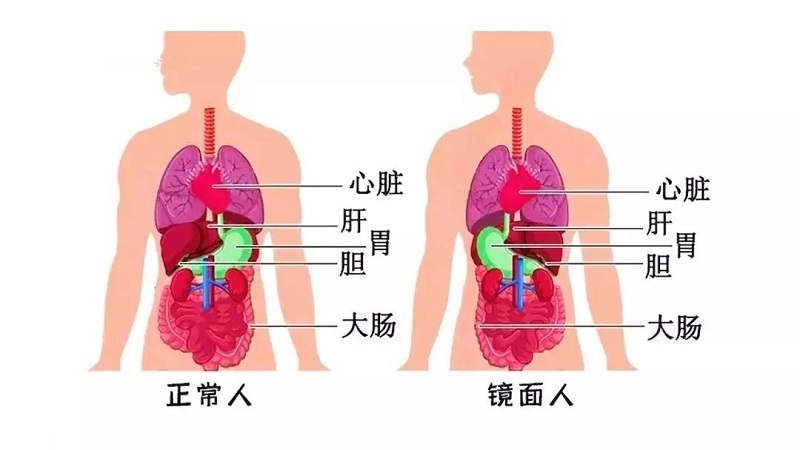 百萬分之一罕見“鏡面人”！五臟六腑反著長，手術也得反著來！