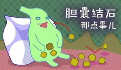 【健康科普】 膽囊結(jié)石 你知多少？