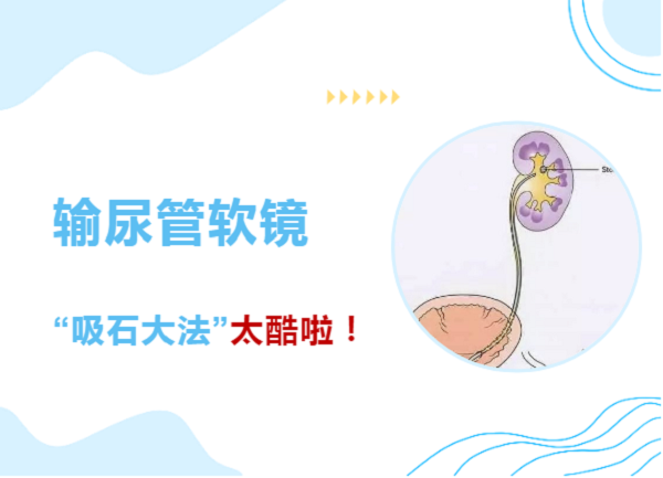 泌尿外科超強絕技上線-輸尿管軟鏡下的“吸石大法”